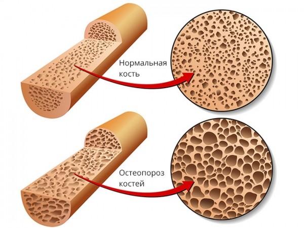 Что такое остеопороз, симптомы и причины болезни костей